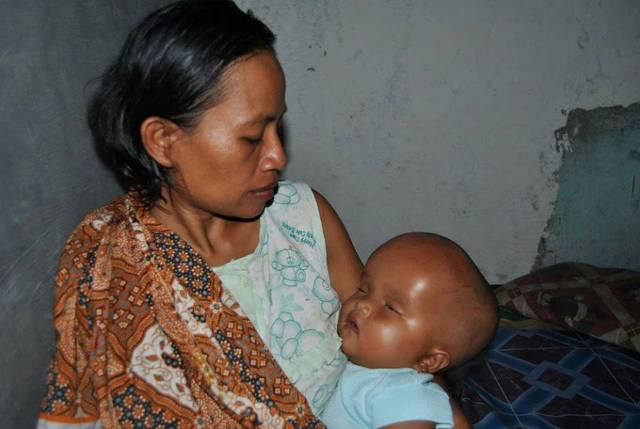 Membutuhkan Bantuan: Sela (hidrocepallus)